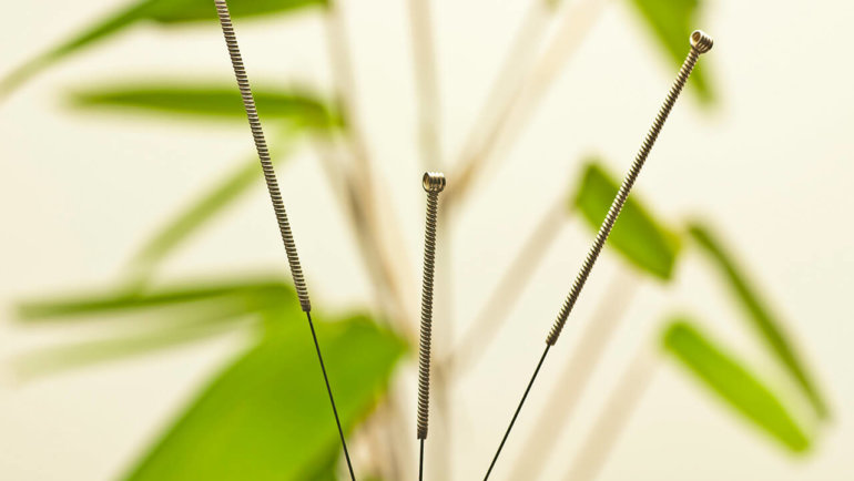 What’s the difference between dry needling and acupuncture?