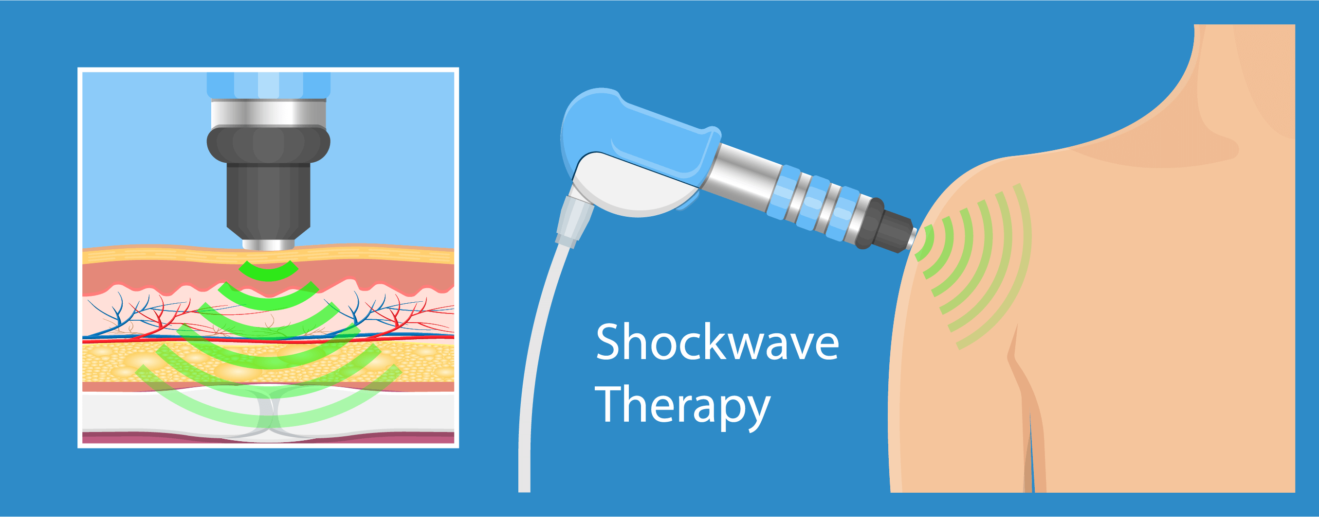 Shockwave therapy SWT physiotherapist treat muscular disorder back neck physical tennis Elbow muscle stimulator ultrasound calcific tendonitis